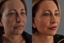 before and after facial fat grafting right angle view female patient case 1777