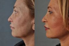before and after facial fat grafting left side view female patient case 1777