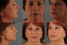 before and after facial fat grafting multiple view female patient case 1785