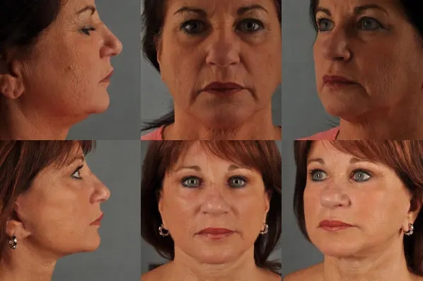 before and after facial fat grafting multiple view female patient case 1785