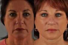 before and after facial fat grafting front view female patient case 1785