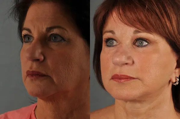 before and after facial fat grafting left angle view female patient case 1785