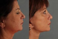 before and after facial fat grafting right side view female patient case 1785