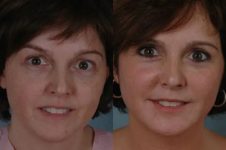 before and after facial fat grafting front view female patient case 1804