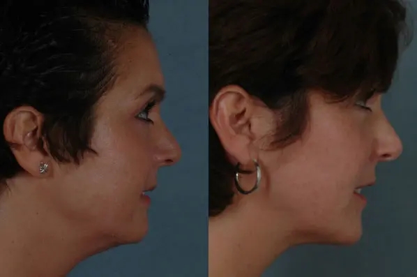 before and after facial fat grafting right side view female patient case 1804