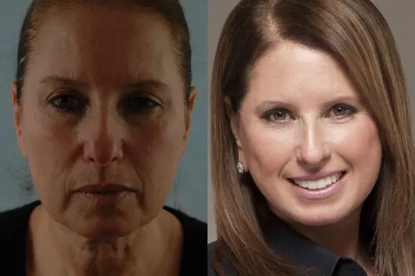 before and after facial fat grafting front view female patient case 1814