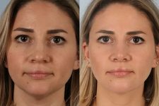 before and after facial fat grafting front view female patient case 1824