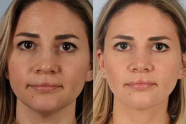before and after facial fat grafting front view female patient case 1824