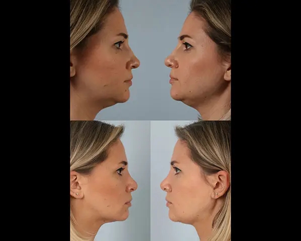 before and after facial fat grafting profile view female patient case 1824