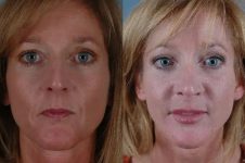 before and after facial fat grafting front view female patient case 1833