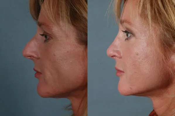 before and after facial fat grafting left side view female patient case 1833