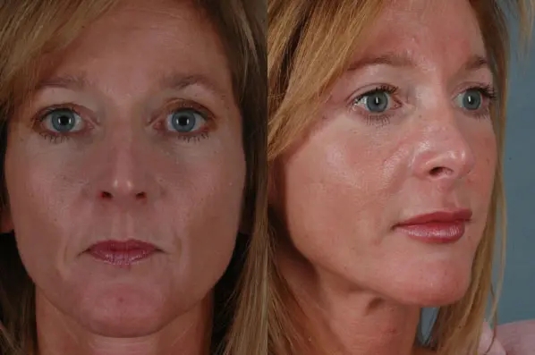 before and after facial fat grafting multiple view female patient case 1833