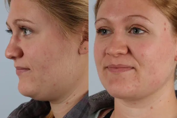 before and after facial fat grafting left view female patient case 1838