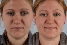 before and after facial fat grafting front view female patient case 1838