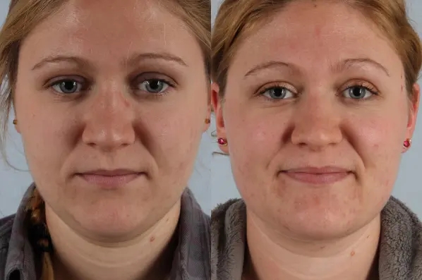 before and after facial fat grafting front view female patient case 1838