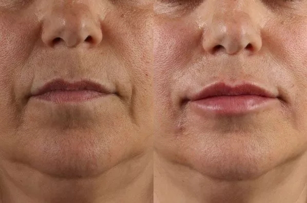 before and after facial rejuvenation front closeup view female patient case 1962
