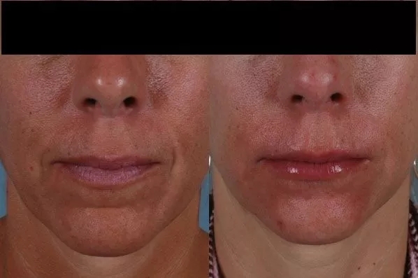 before and after facial rejuvenation front closeup view female patient case 1964