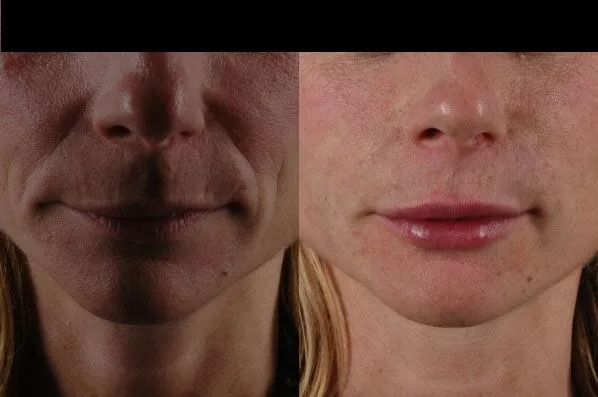 before and after facial rejuvenation front view female patient case 1972