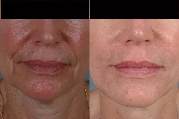 before and after facial rejuvenation front view female patient case 1974