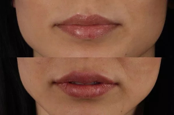 before and after filler front view female patient case 1976