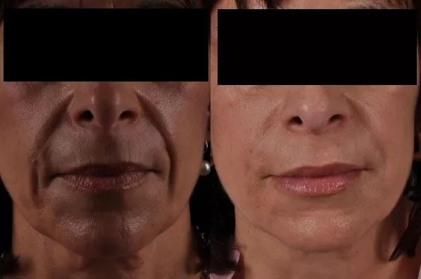 before and after facial rejuvenation front view female patient case 1978