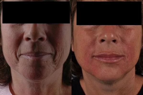 before and after facial rejuvenation front view female patient case 1980
