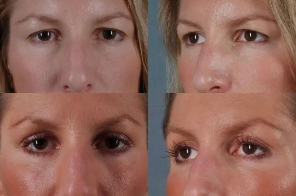 before and after facial rejuvenation front closeup view female patient case 1987