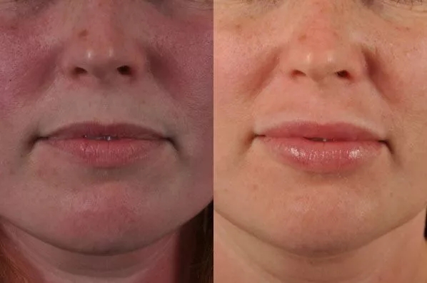 before and after filler front closeup view female patient case 1990