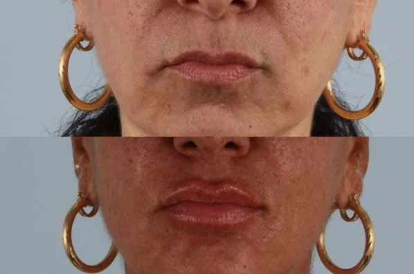 before and after filler front view female patient case 1993
