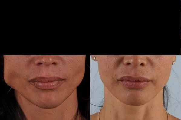 before and after facial rejuvenation front view female patient case 1999