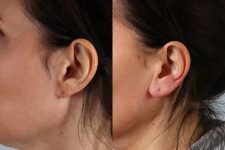 before and after fillers left side view female patient case 2008