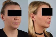 before and after facial rejuvenation right view female patient case 2011