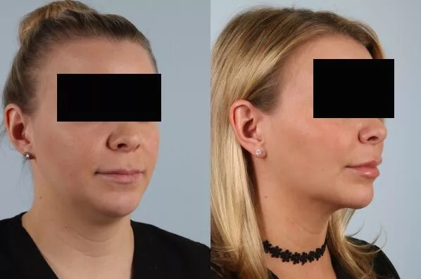 before and after facial rejuvenation right view female patient case 2011