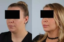 before and after facial rejuvenation left view female patient case 2011
