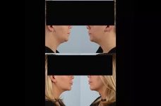 before and after facial rejuvenation side view female patient case 2011