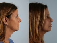 before and after facial rejuvenation right view female patient case 2016