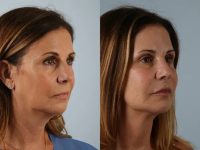 before and after facial rejuvenation right angle view female patient case 2016