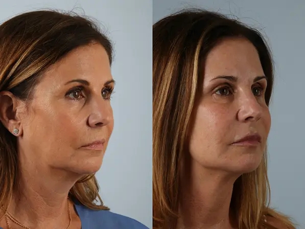 before and after facial rejuvenation right angle view female patient case 2016