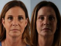 before and after facial rejuvenation front view female patient case 2016