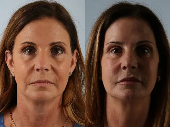 before and after facial rejuvenation front view female patient case 2016