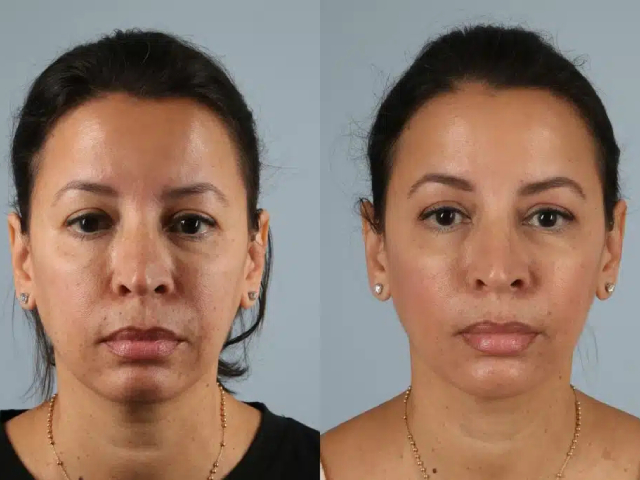 before and after fillers front view female patient case 2031