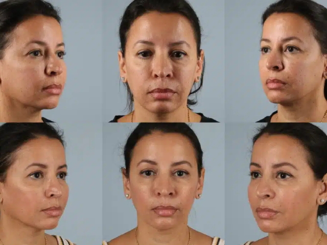 before and after fillers front and side view female patient case 2031