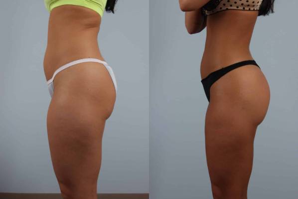 before and after fat grafting female BBL patient side view