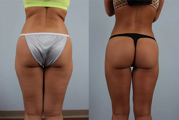 before and after fat grafting female BBL patient back view