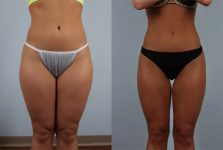 before and after fat grafting female BBL patient front view