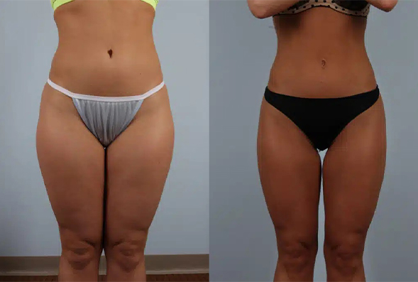 before and after fat grafting female BBL patient front view