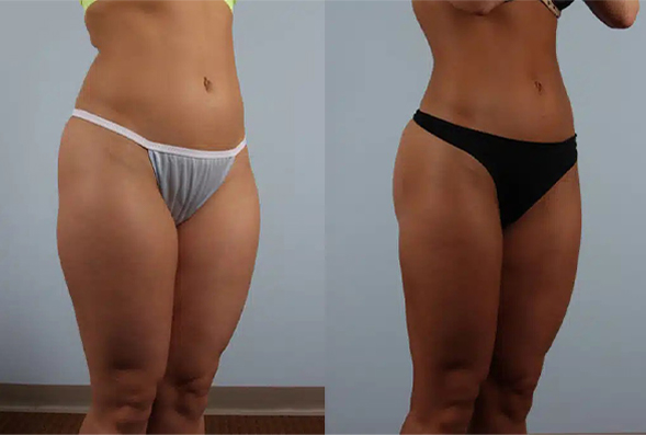 before and after fat grafting female BBL patient angle view