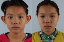 before and after otoplasty front view female patient case 1648