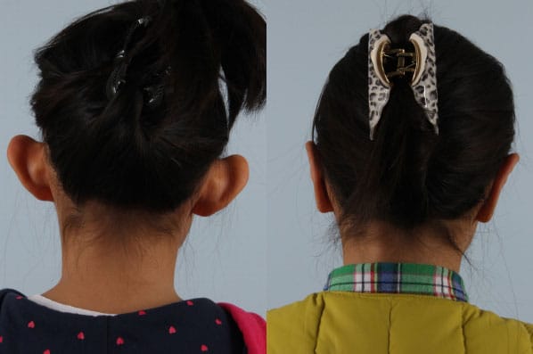 before and after otoplasty back view female patient case 1648