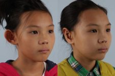 before and after otoplasty right angle view female patient case 1648